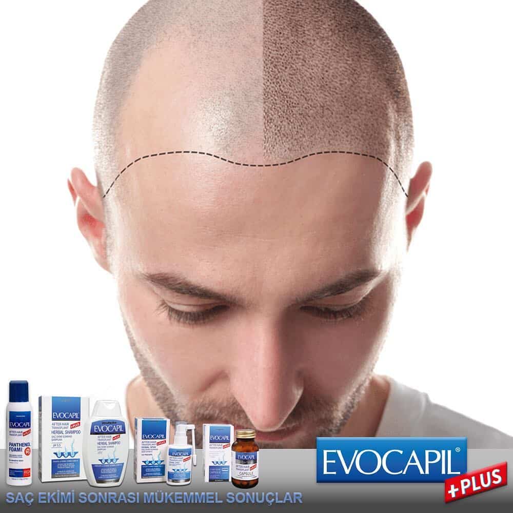 Cuidados após um transplante capilar